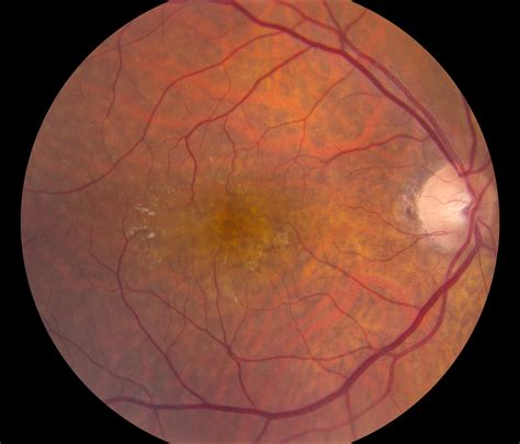 Discovering Hope and Hope in Choroidal Neovascularization Treatment: An Optometrist’s Guide
